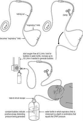 The novel LESS (low-cost entrainment syringe system) O2 blender for use in modified bubble CPAP circuits: a clinical study of safety